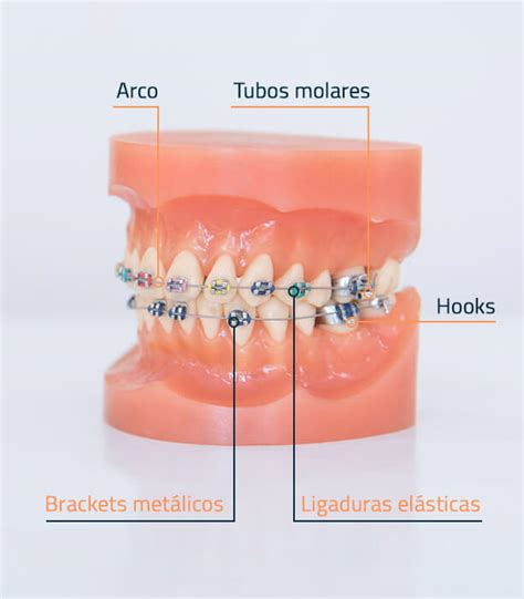 partes de un bracket metalico|Partes de un bracket: conoce todas sus piezas.